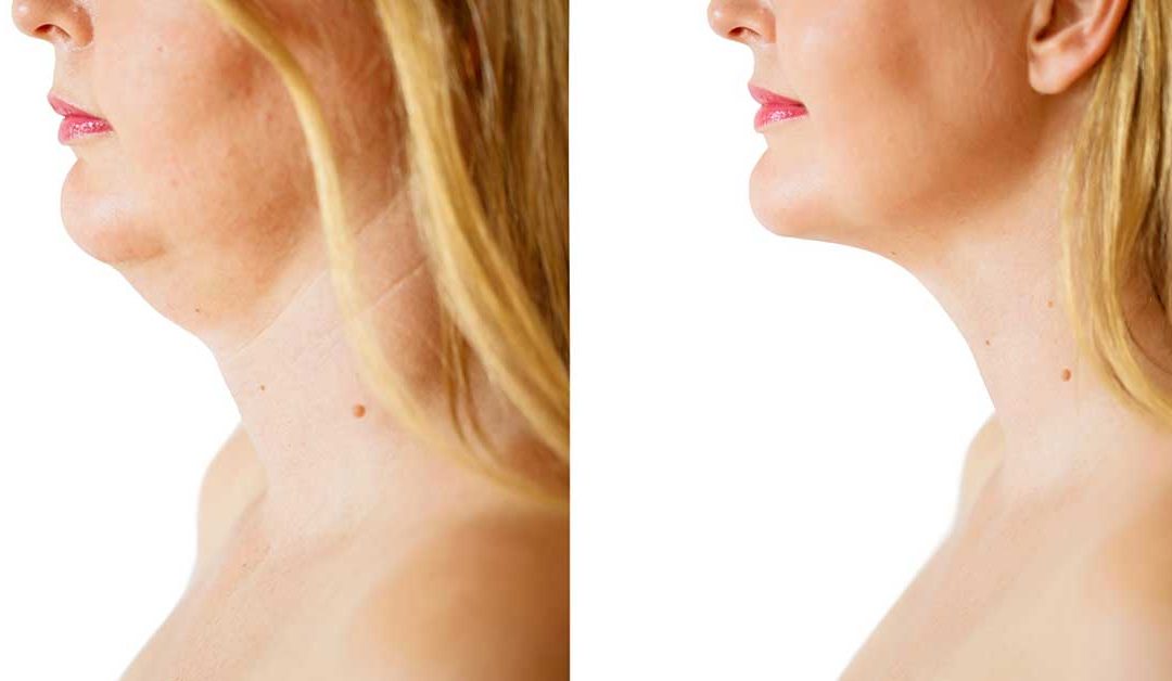 HIFU Treatments: Does HIFU Work on a Double Chin?