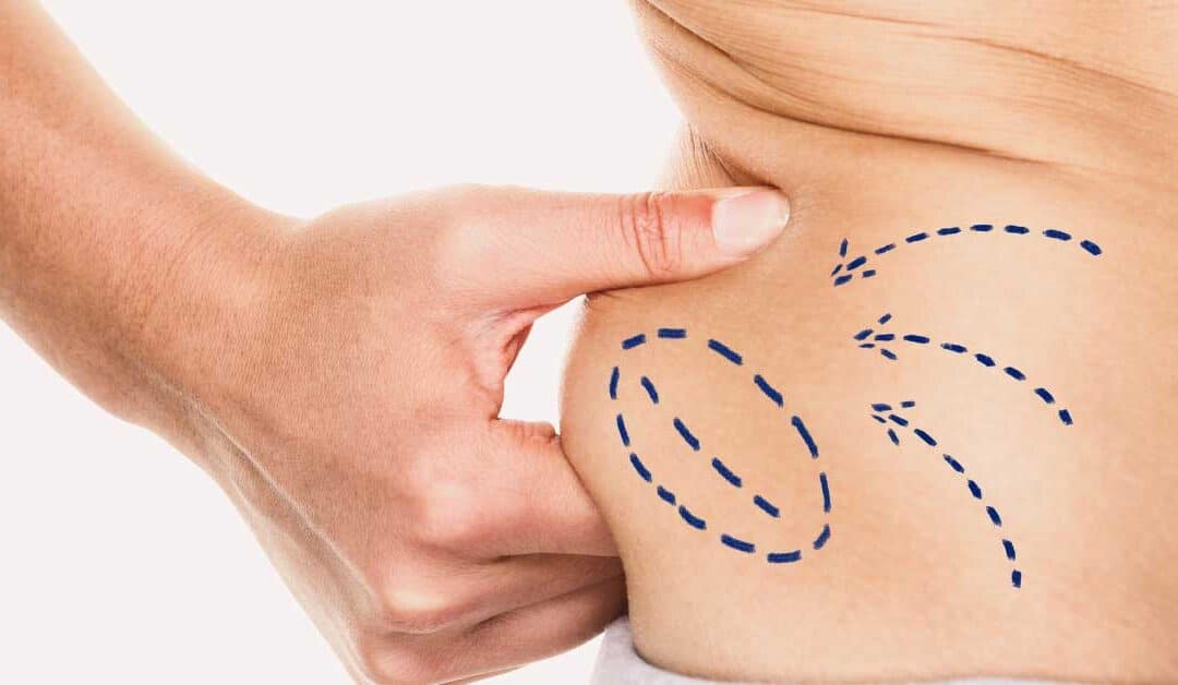 HIFU and Fat Reduction: A Non-Invasive Solution